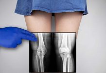 Khắc phục và chỉnh hình chân vòng kiềng