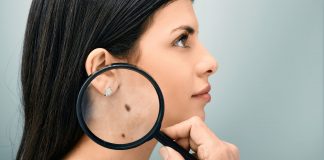 Chăm sóc sau tẩy nốt ruồi sao cho an toàn, không sẹo?